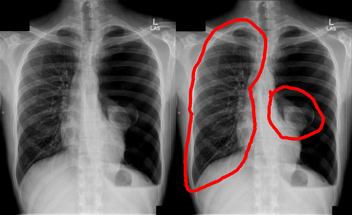 Collapsed Lung X Ray